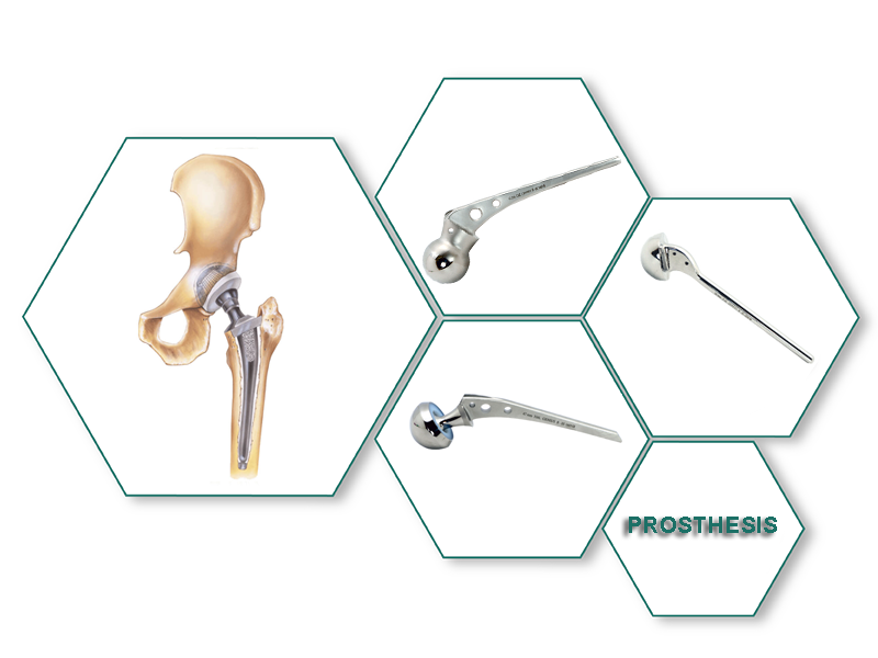 Prosthesis